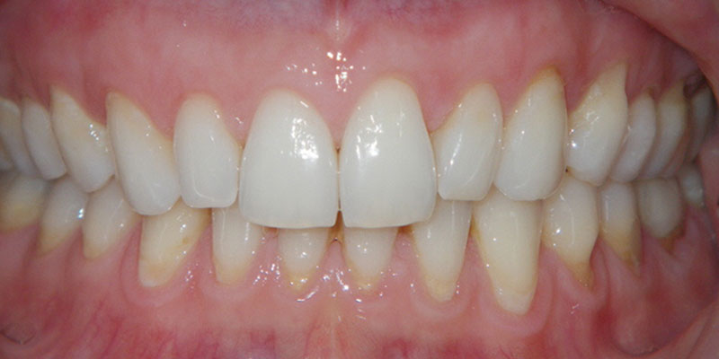 Invisalign Smile Gallery