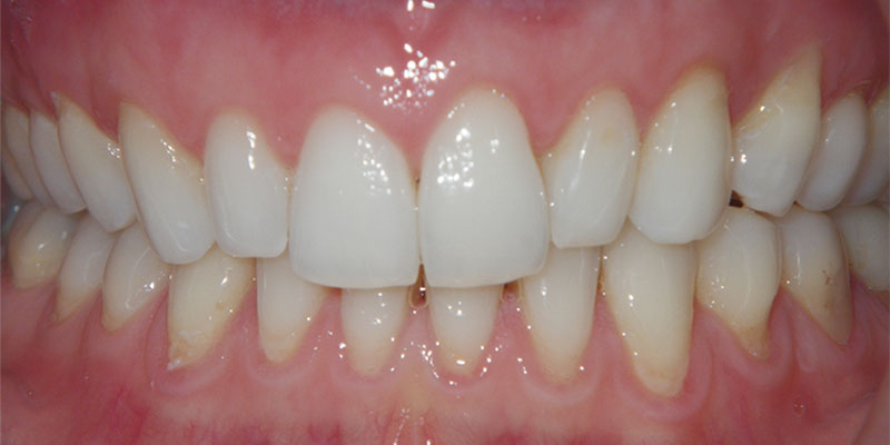 Invisalign Smile Gallery