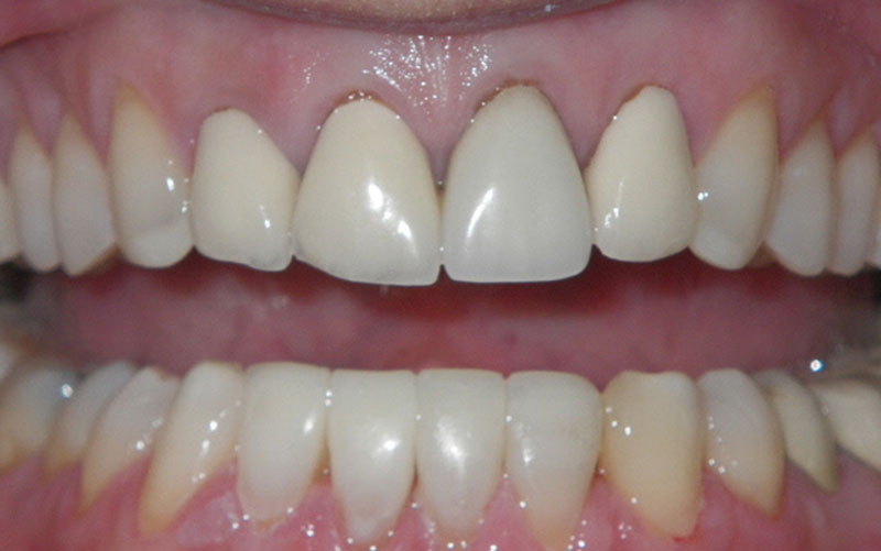 Veneer &#038; Composite Bonding Smile Gallery