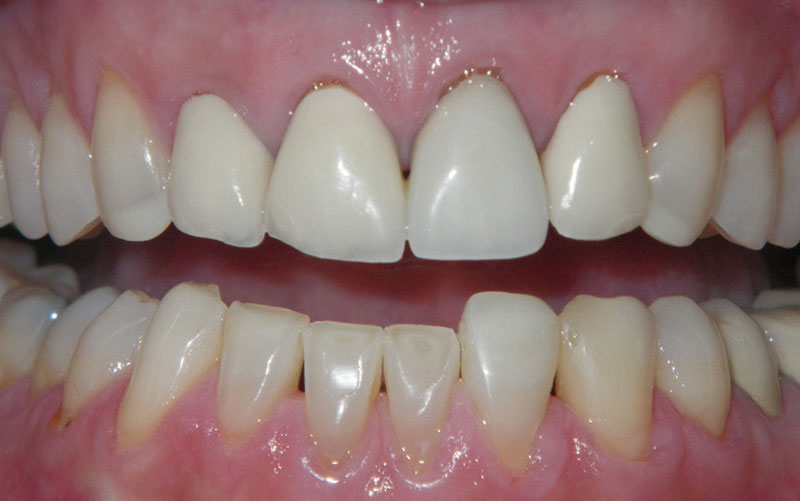 Veneer &#038; Composite Bonding Smile Gallery