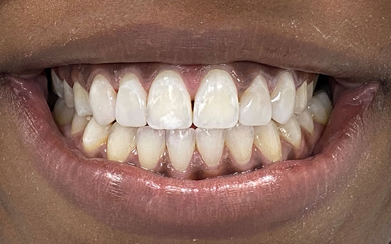 Veneer &#038; Composite Bonding Smile Gallery