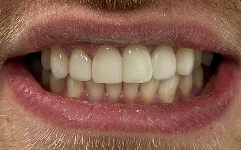 Veneer &#038; Composite Bonding Smile Gallery