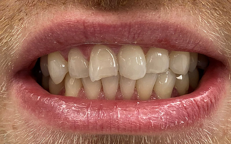 Veneer &#038; Composite Bonding Smile Gallery