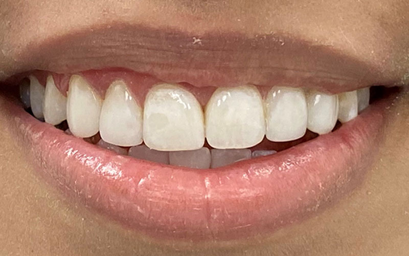 Veneer &#038; Composite Bonding Smile Gallery