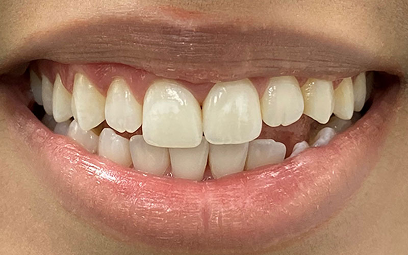 Veneer &#038; Composite Bonding Smile Gallery