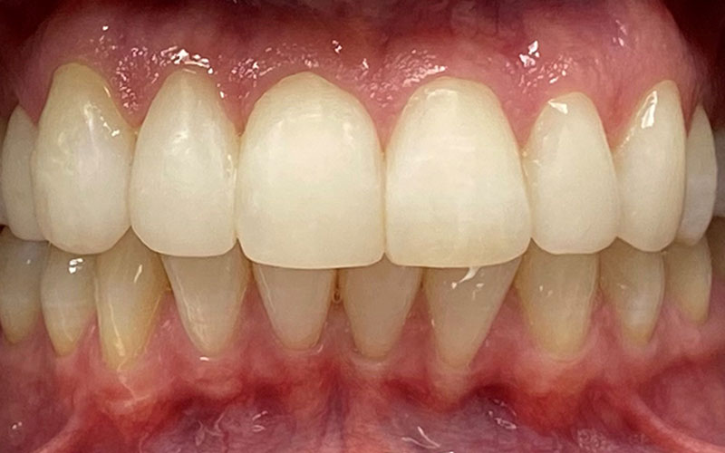 Veneer &#038; Composite Bonding Smile Gallery