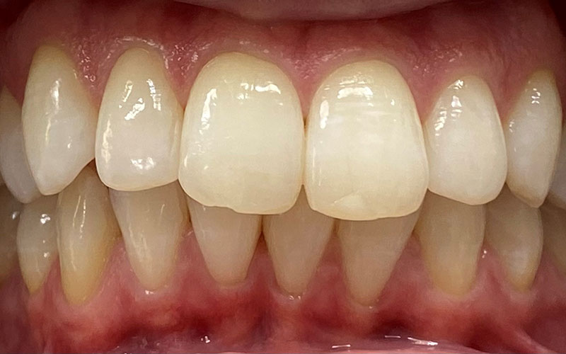 Veneer &#038; Composite Bonding Smile Gallery