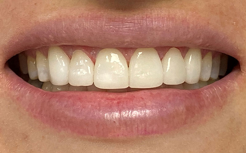 Veneer &#038; Composite Bonding Smile Gallery