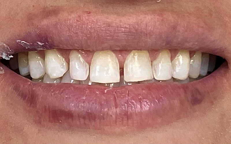 Veneer &#038; Composite Bonding Smile Gallery