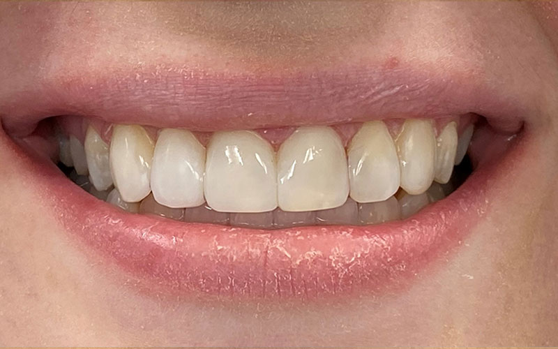 Veneer &#038; Composite Bonding Smile Gallery