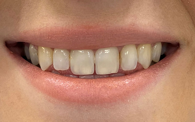 Veneer &#038; Composite Bonding Smile Gallery