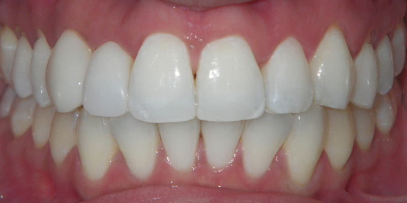 Invisalign Smile Gallery