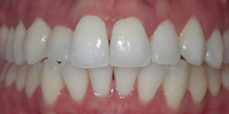 Invisalign Smile Gallery