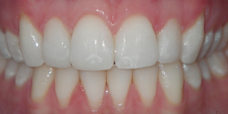 Invisalign Smile Gallery