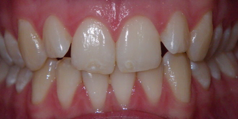 Invisalign Smile Gallery