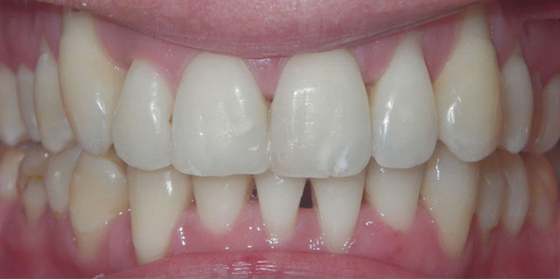 Invisalign Smile Gallery